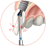 asc-screw-channel-abutment