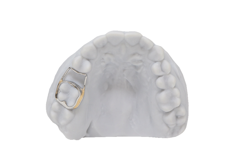 Cast Space Maintainer RDL Russellville Dental Lab