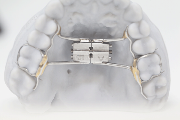 Hyrax Rapid Palatel Expander RDL Russellville Dental Lab