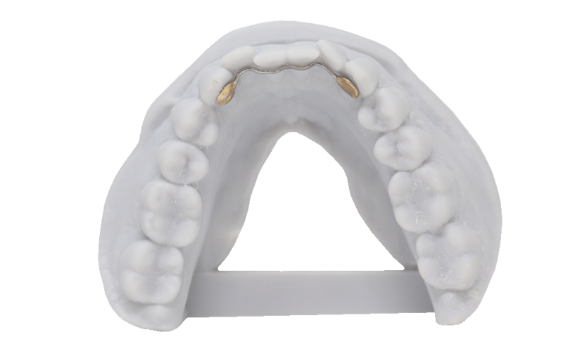 Lingual Retainer Rdl Russellville Dental Lab