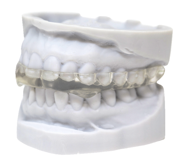 Hard Occlusal Splint RDL Russellville Dental Lab