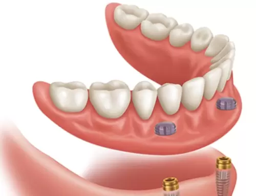 Locator Overdentures: Advantages and Features