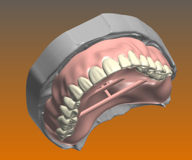 Traditional Impression, Digital Denture, Wax Rim Only Workflow (ED3P) (3 Visits) RDL